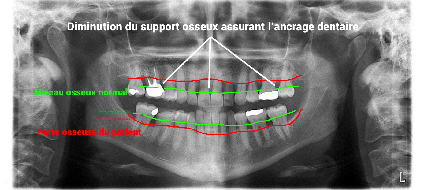 Conséquences locales de la maladie parodontale - diminution du support osseux - Cabinet Dentaire Les Dauphins - Baie-Mahault - Guadeloupe