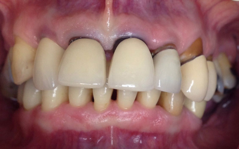 Etat parodontal d'un patient - Cabinet Dentaire Les Dauphins - Baie-Mahault - Guadeloupe