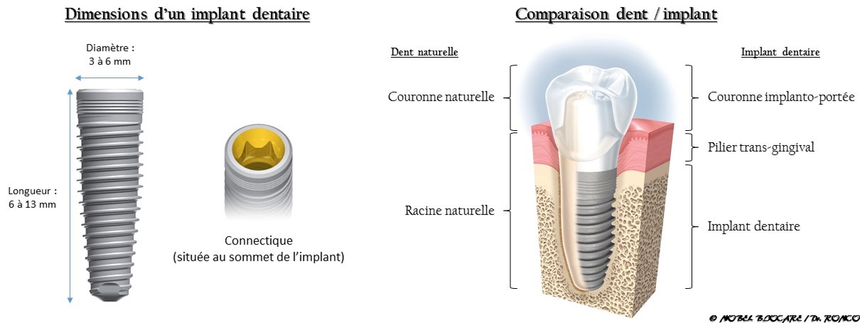 implant dentaire - cabinet dentaire Les Dauphins