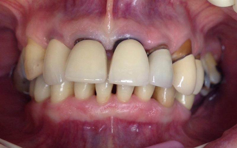 maladie parodontale - cabinet dentaire Les Dauphins