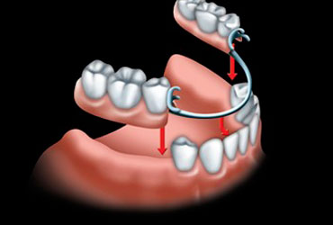 Prothèse amovible - Cabinet dentaire Les Dauphins