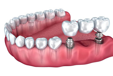 Prothèse supra implantaire - Cabinet dentaire Les Dauphins