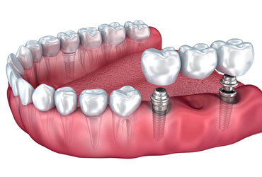 Implantologie - Cabinet dentaire Les Dauphins